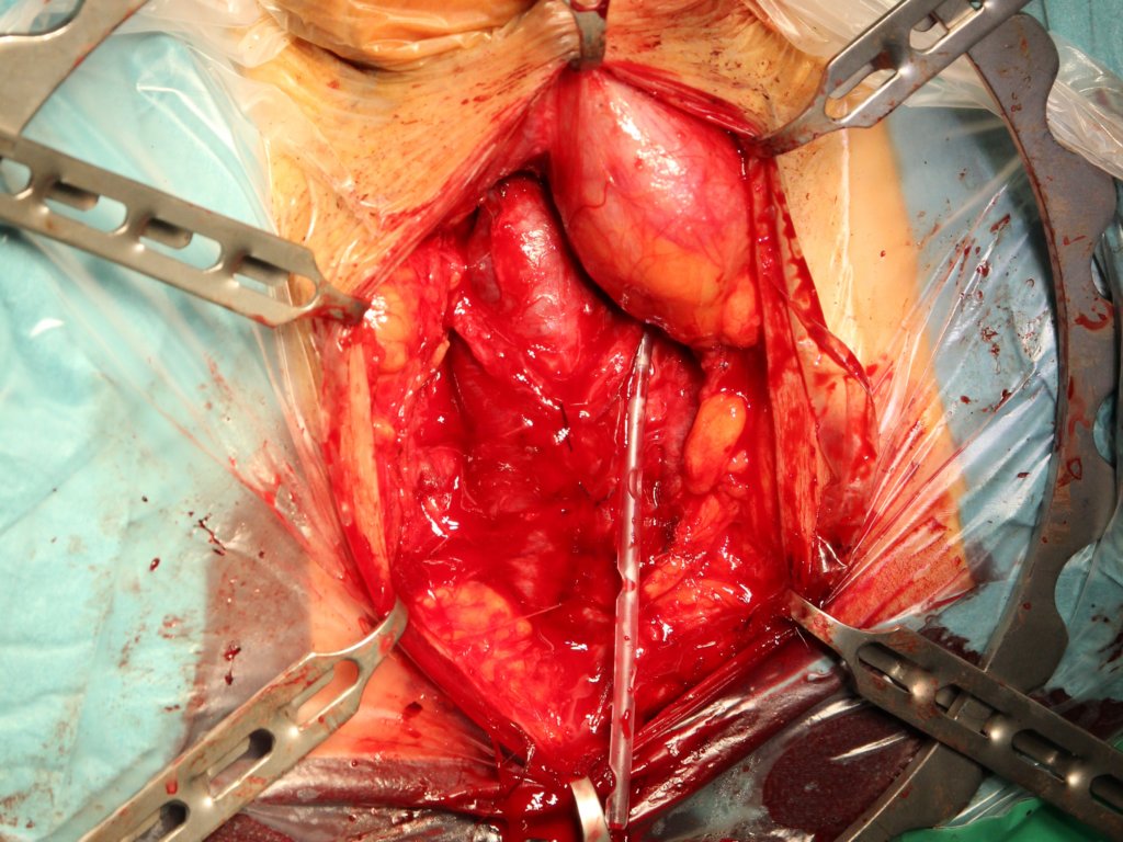 bulbospongiousmusclesuturing5.jpg