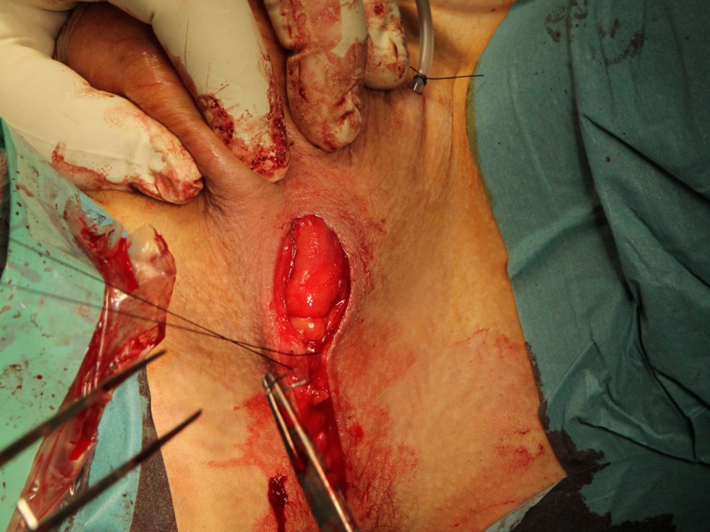 subcutaneoussutures5.jpg